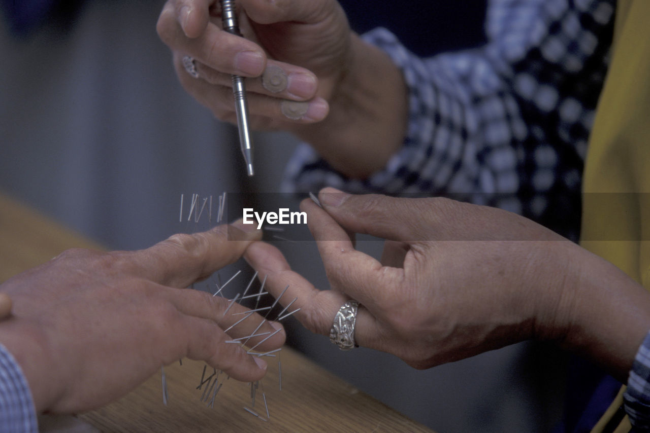 Cropped image of person getting acupuncture treatment