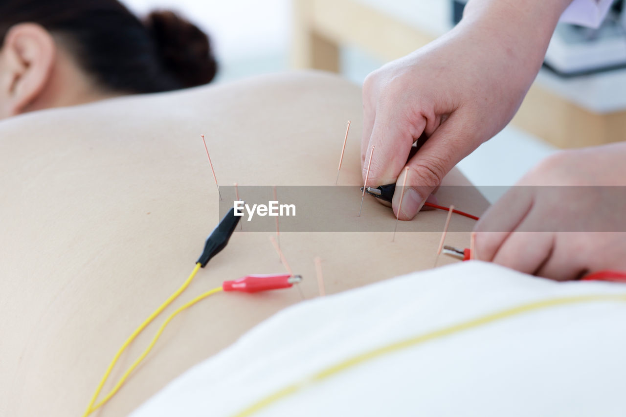 Midsection of doctor treating patient with acupuncture therapy in clinic