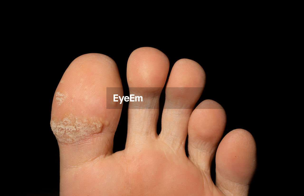 Close-up of injured barefoot against black background