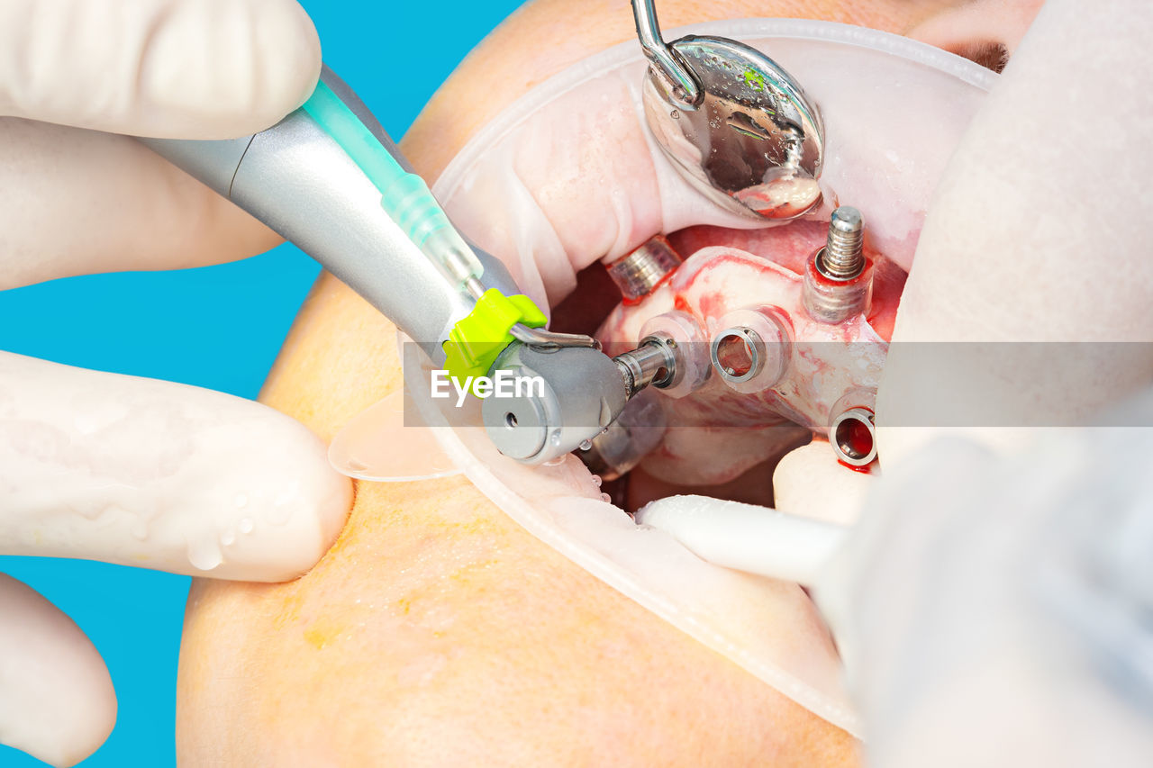 Close up of digital guided implant surgery on patient - new implant technology in dentistry.