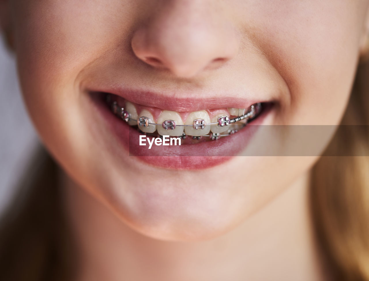 Close-up of smiling girl wearing braces