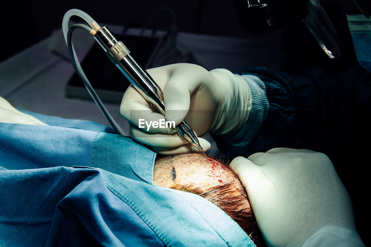 Close up hand of surgeon with surgical equipment making surgery hair transplant on head 