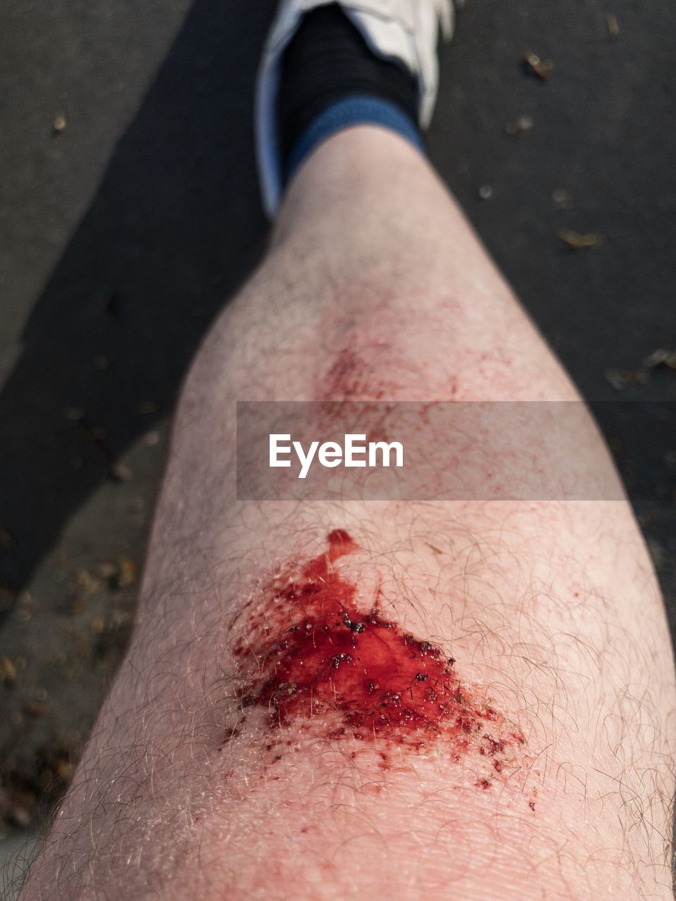 Close-up injured knee