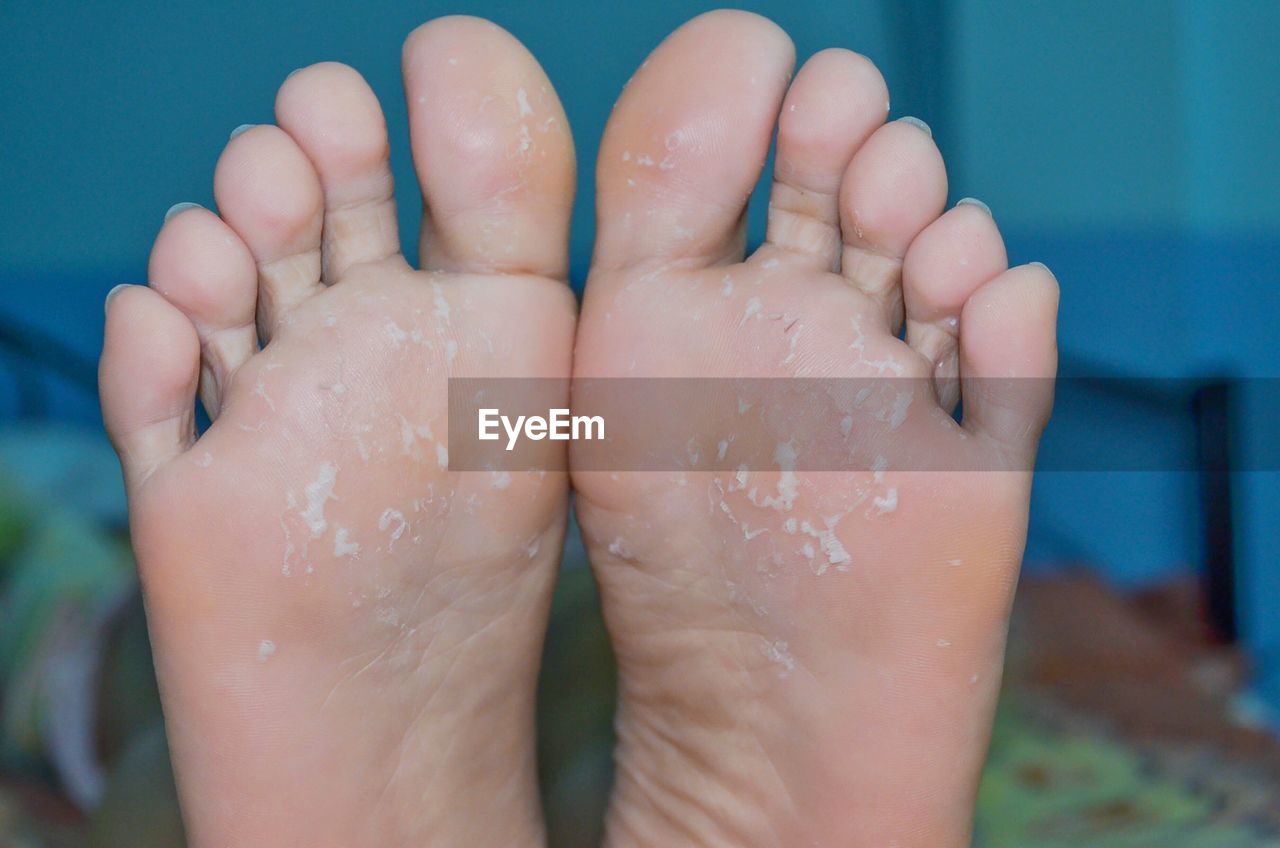 Close-up of injured barefeet