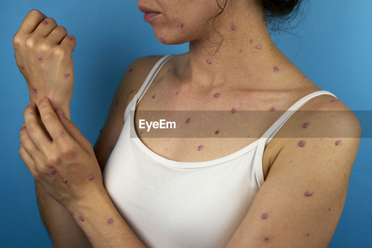 Viral rash on woman's body because of monkeypox disease