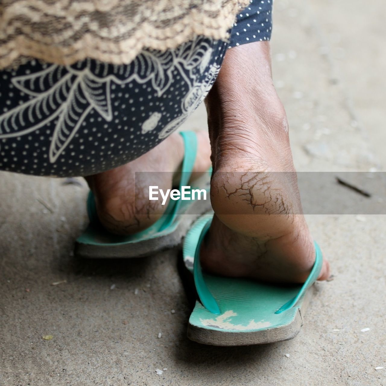 Close up of cracked soles of woman's feet