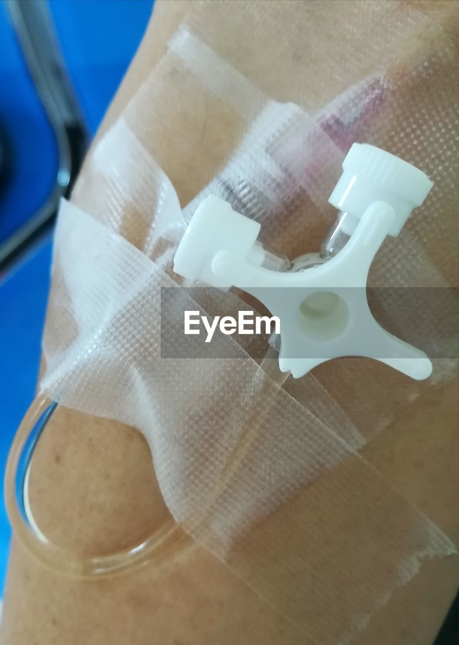 High angle view of iv drip in hand at hospital