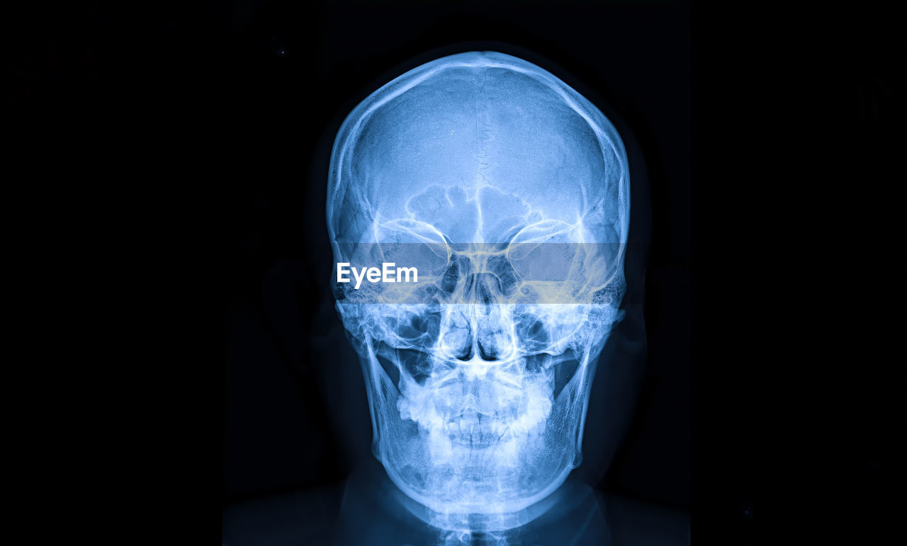 Medical x-ray of human head against black background