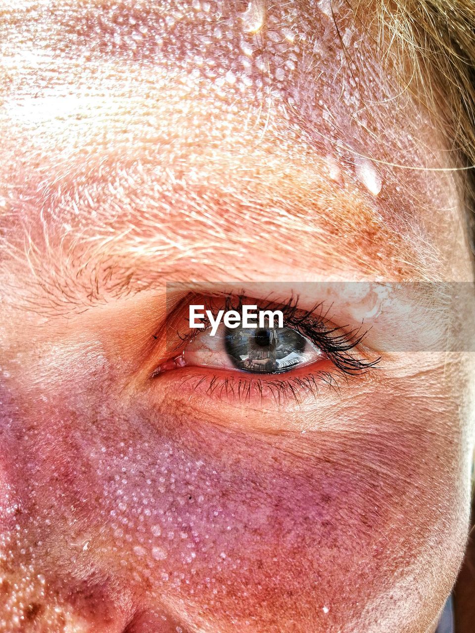 Cropped image of woman with sunburned face