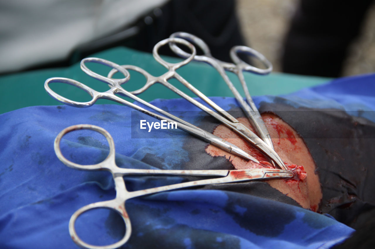 Close-up of scissors on patient body at hospital