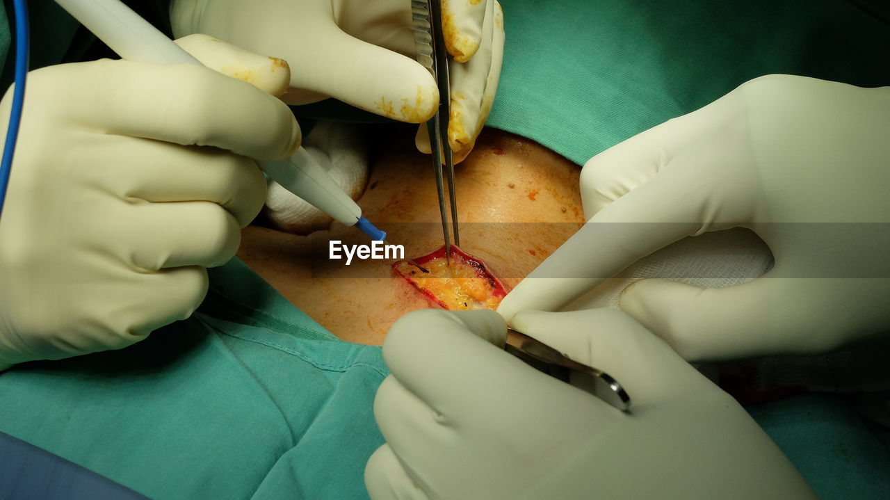 Cropped hands of doctor performing surgery on patient at hospital