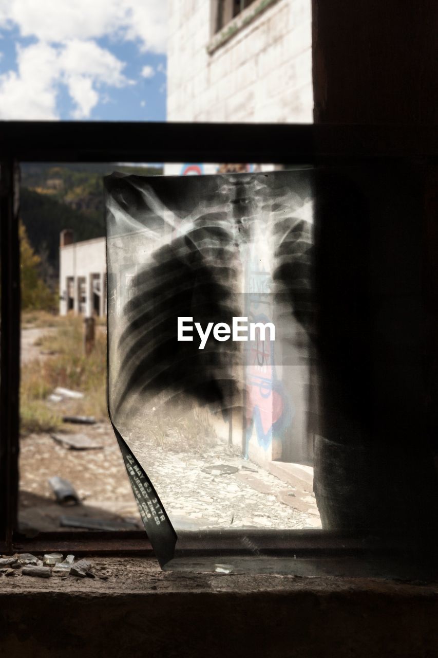 Chest x-ray on window