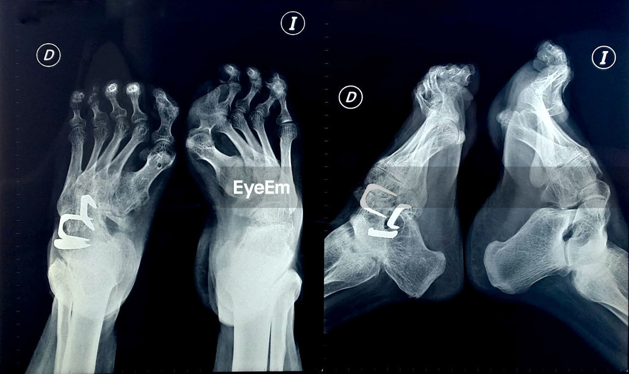 X ray of side view and top view of deformed bones of feet with foreign bodies