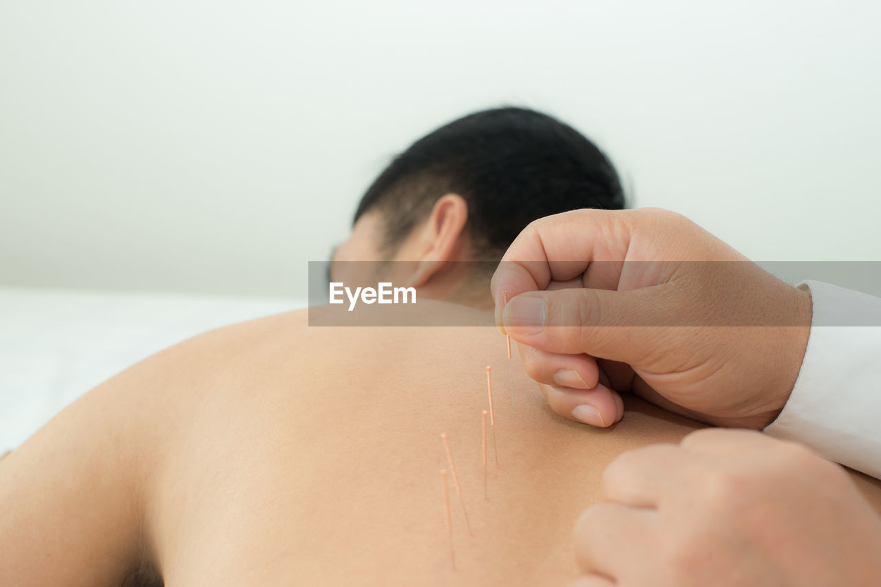 Cropped hands of person inserting acupuncture needle on man back