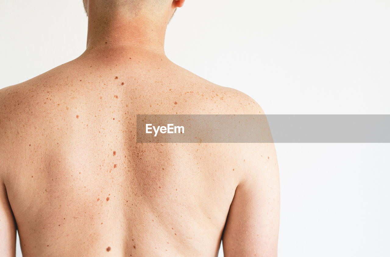 Pigmentation. close up detail of the bare skin on a man back with scattered moles and freckles.