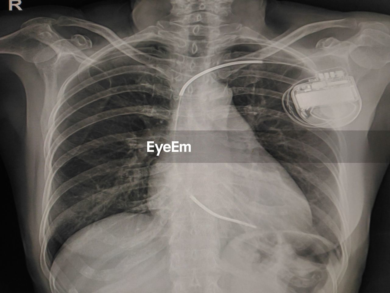 Close-up of x-ray of chest