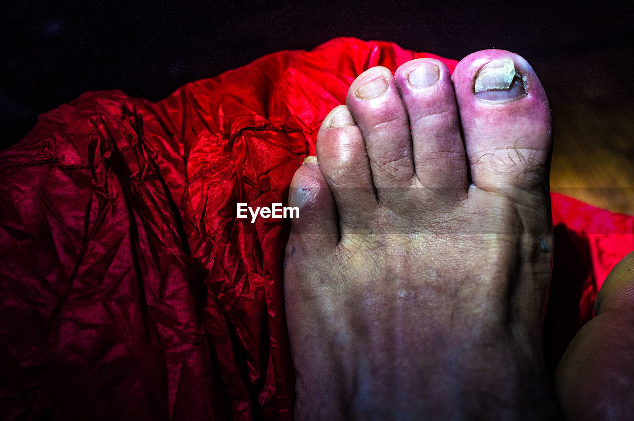 Low section of person with injured toenail