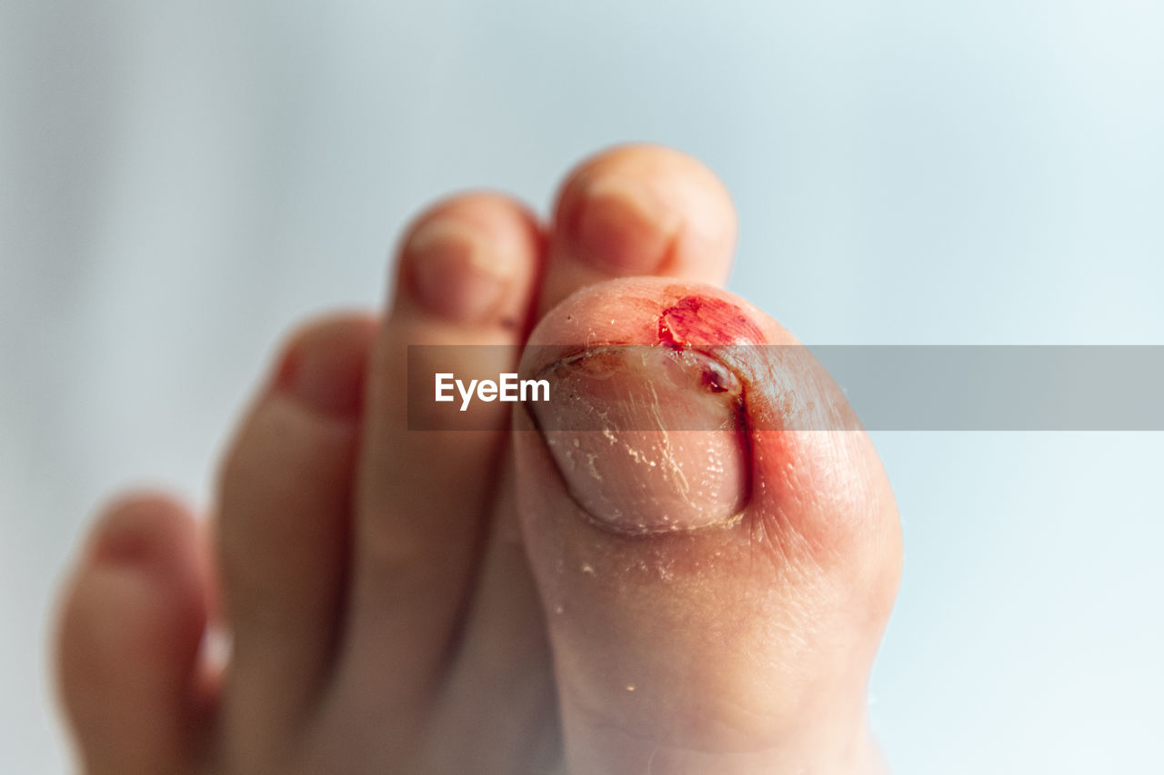 Close-up of bleeding toenail against wall