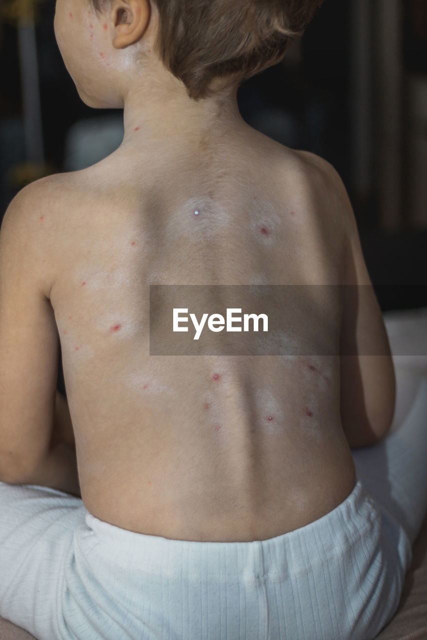 Rear view of boy infected with chickenpox 