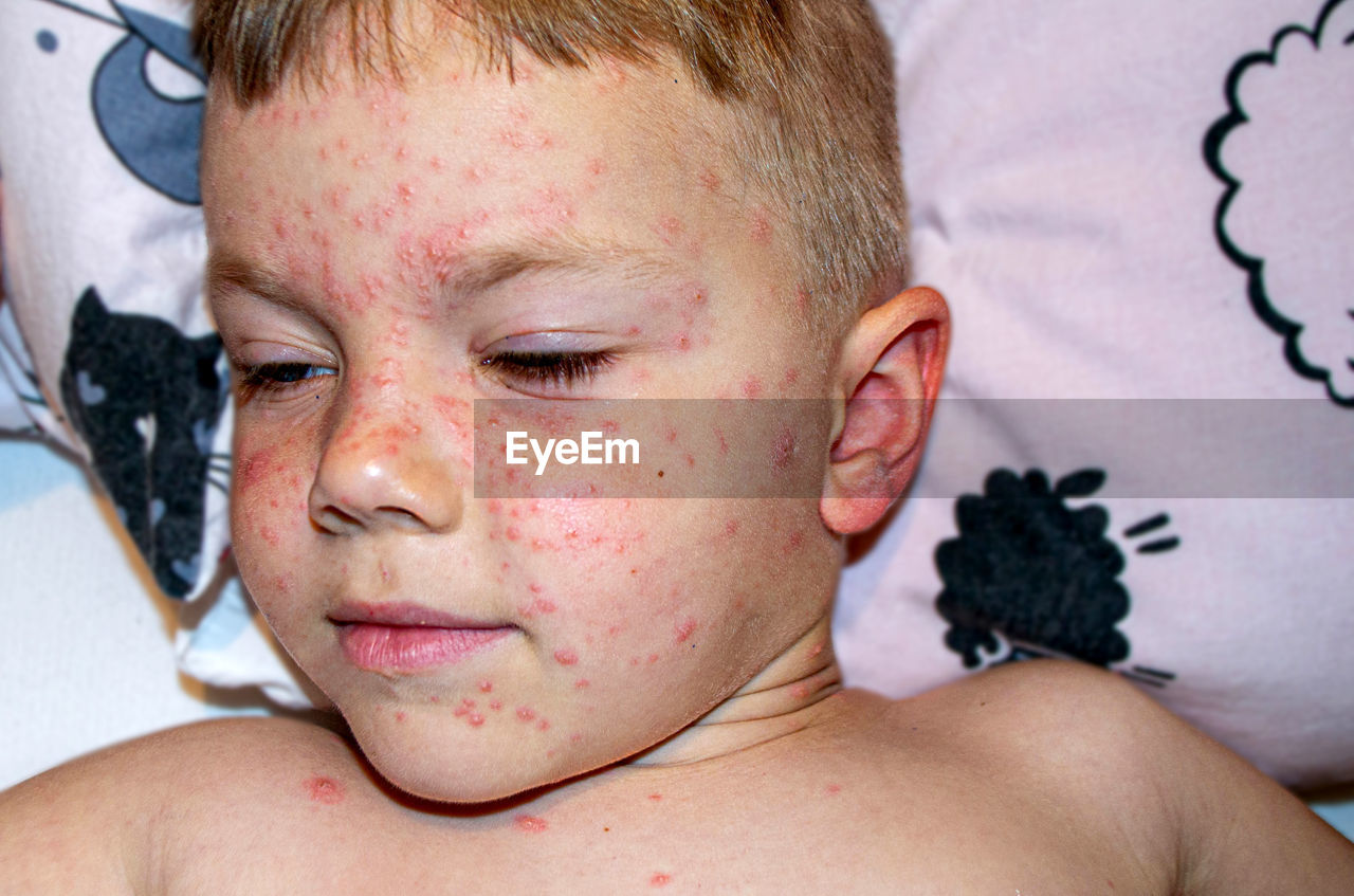 Varicella virus or chickenpox bubble rash on child