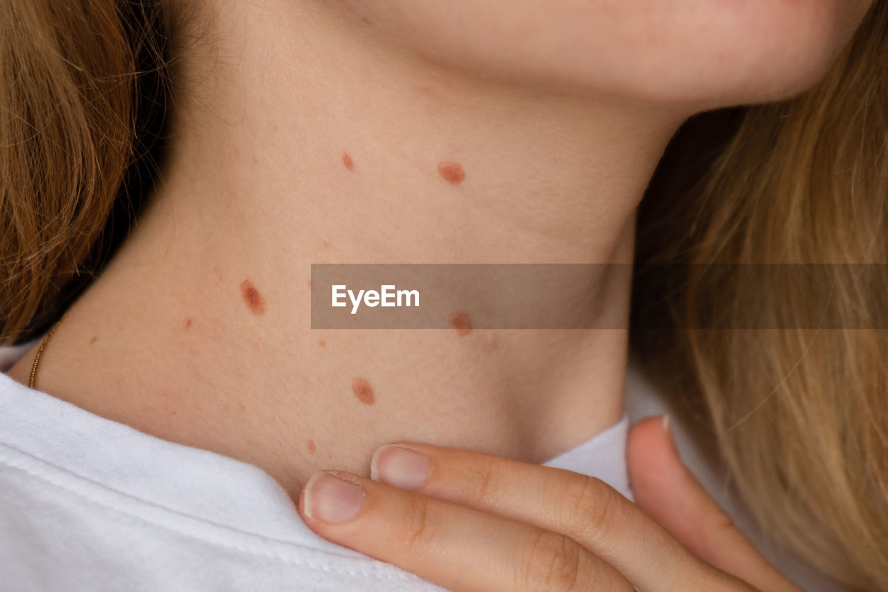 Unrecognizable woman showing her birthmarks on neck skin close up detail of the bare skin sun