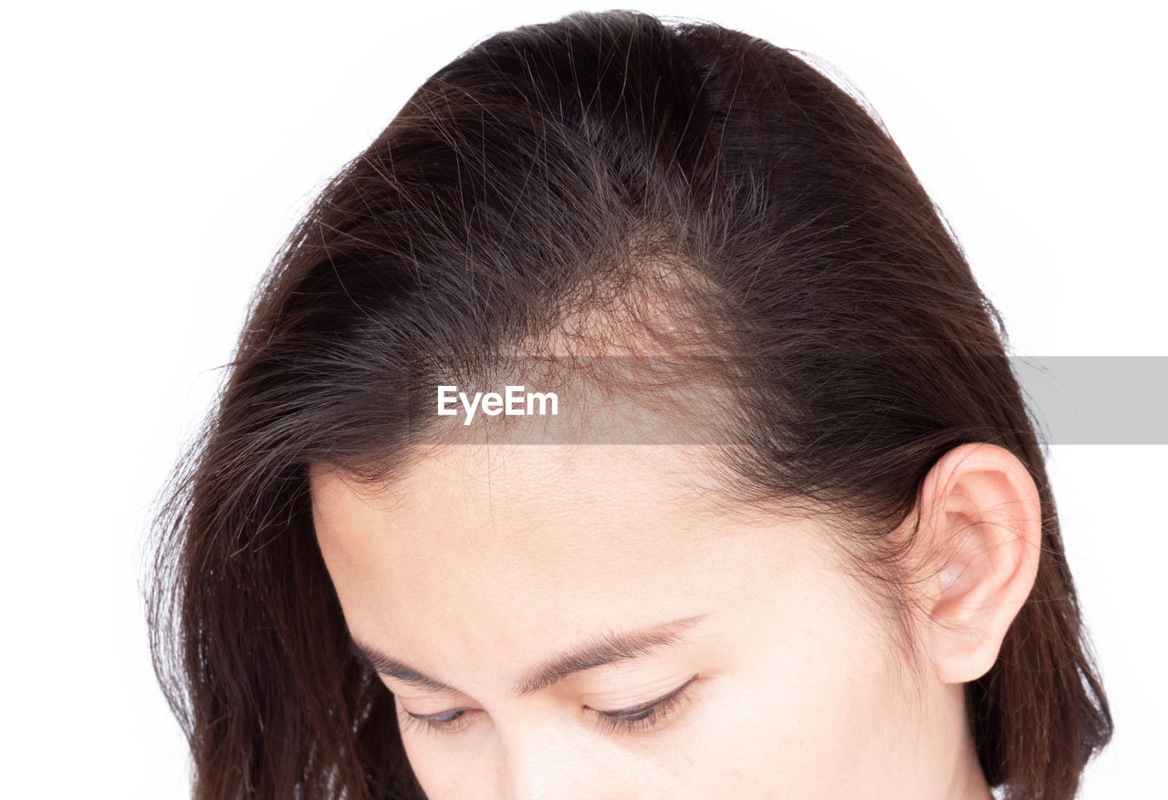 Close-up of woman with receding hairline against white background