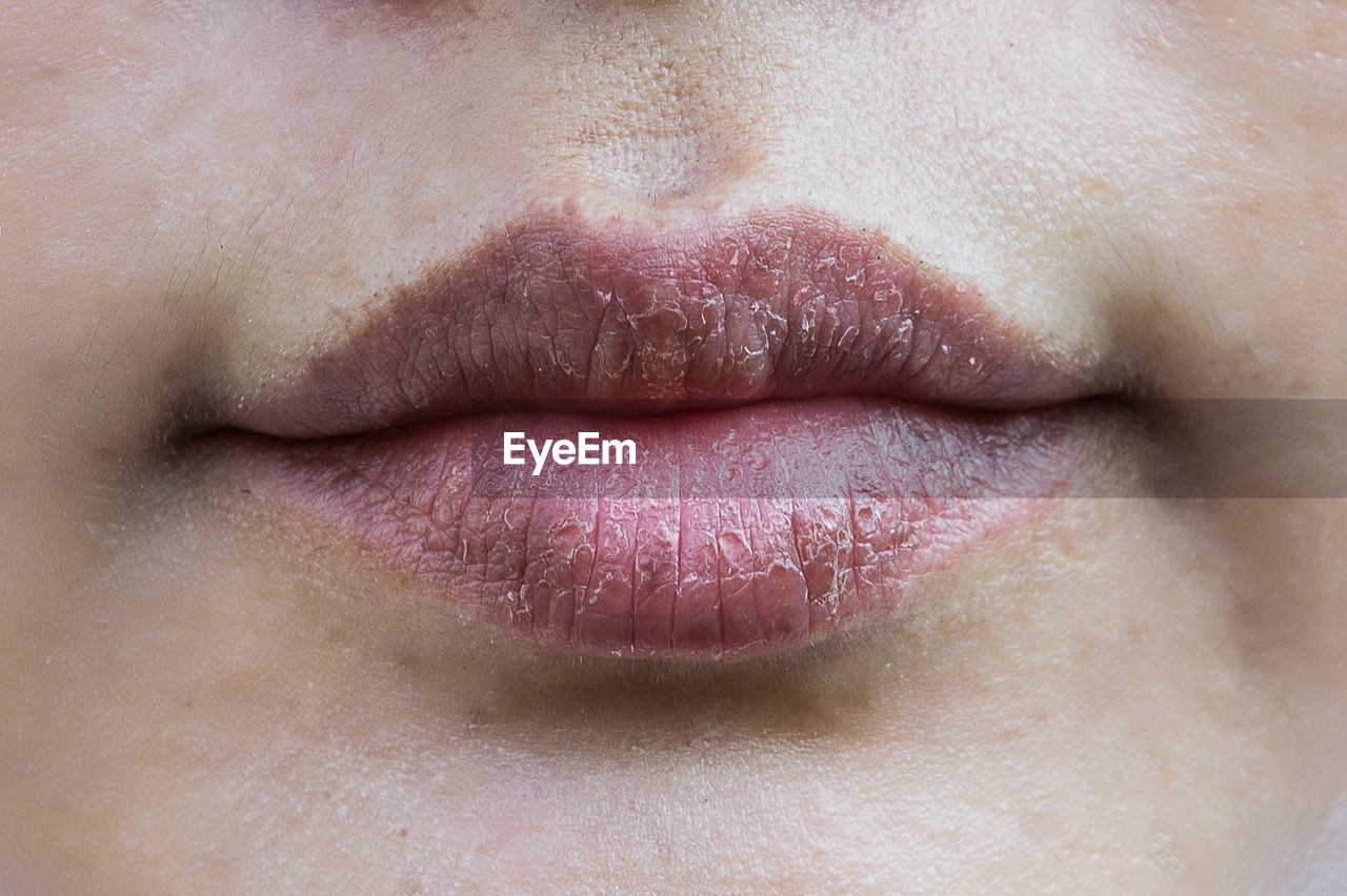 Full frame shot of woman with dry lips