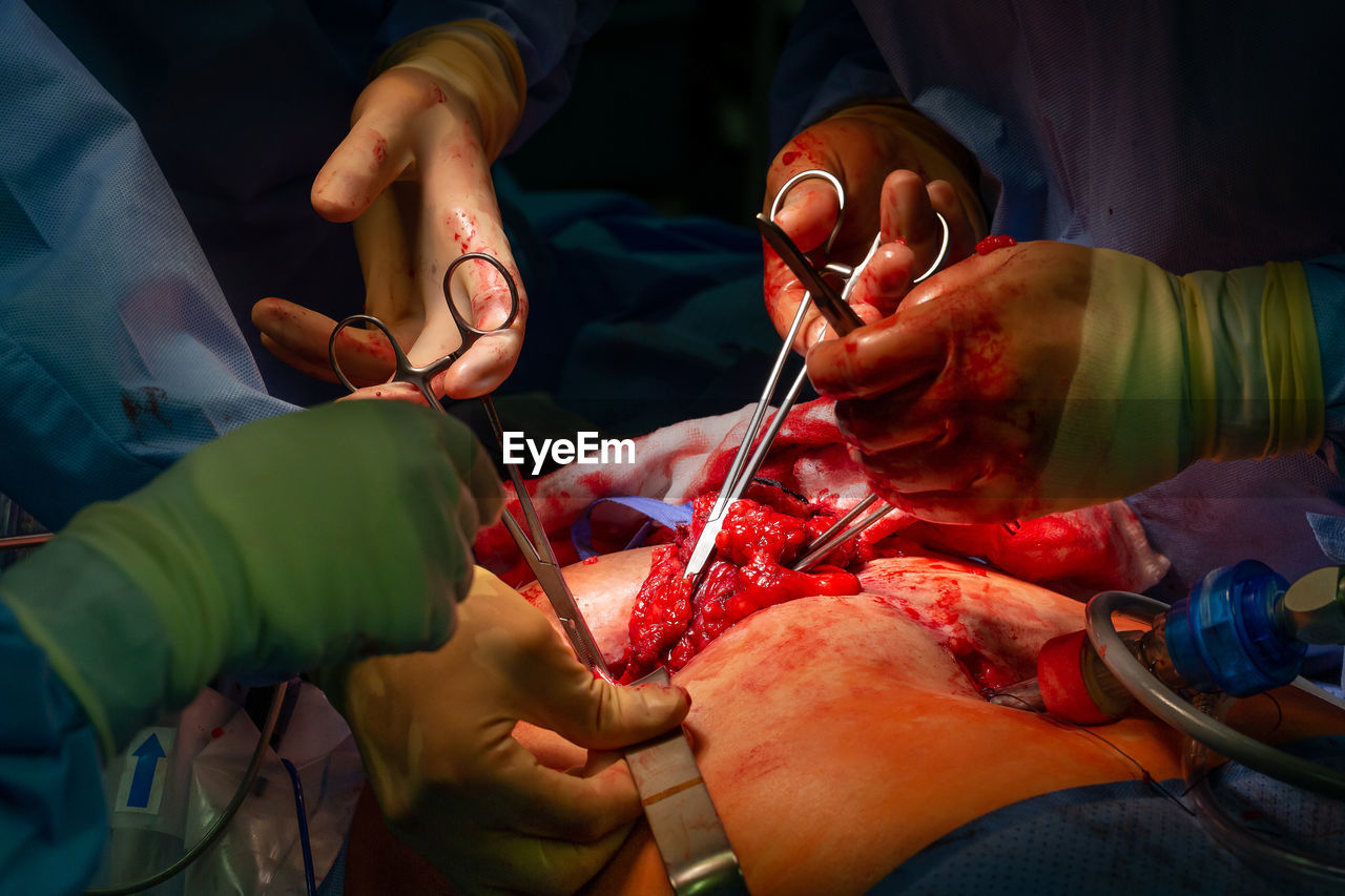 Surgical operation, closeup on operating field and hands of surgeons