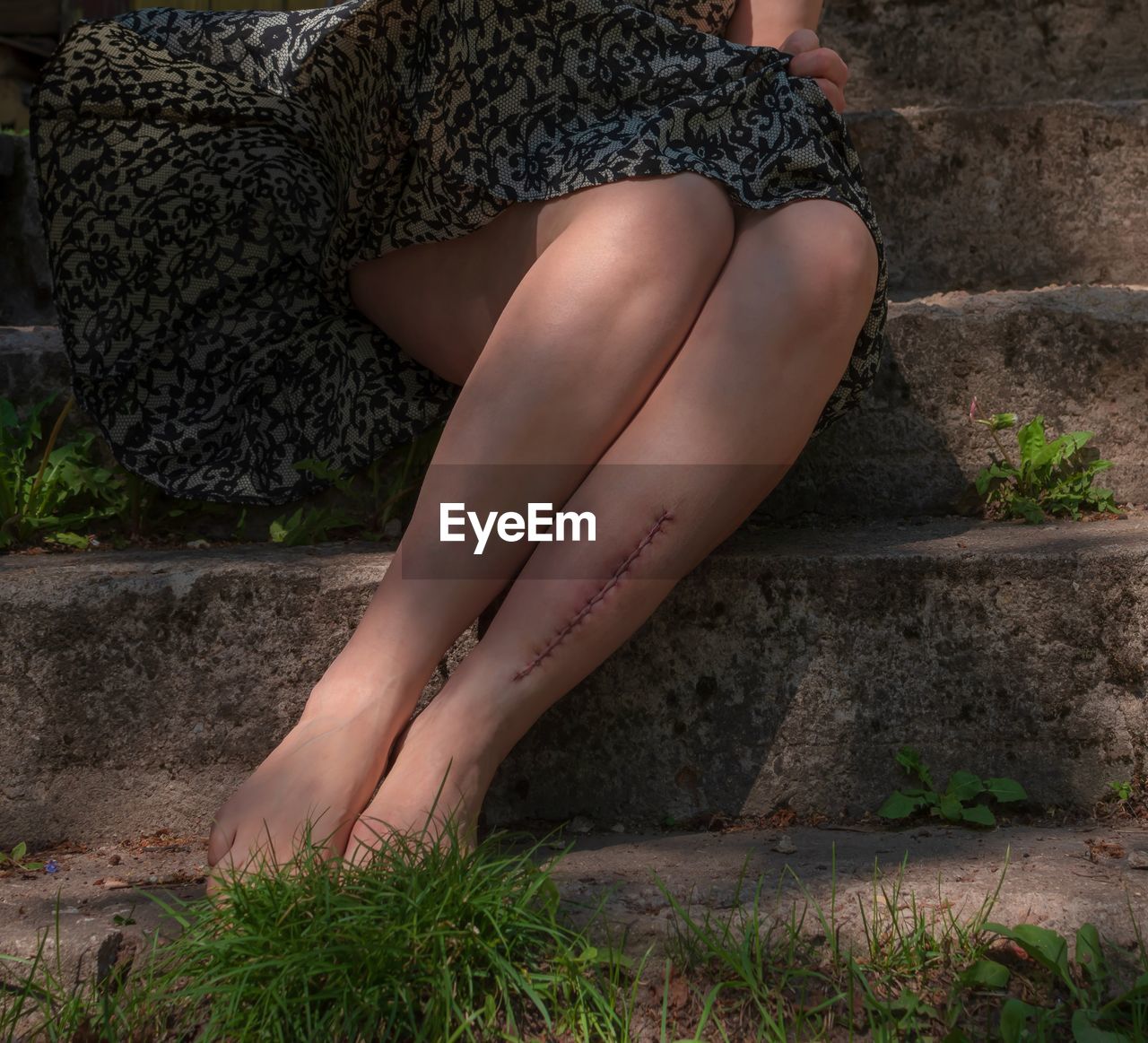 Low section of woman with stitches sitting on steps