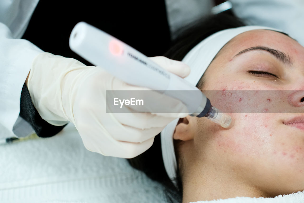 Closeup view of woman having microneedling procedure applied on her face