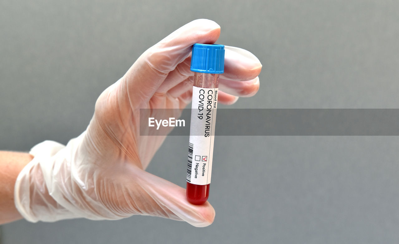 Coronavirus test blood sample positive result on white background.