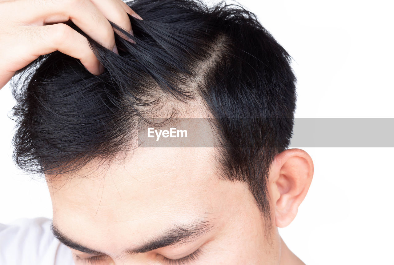 Close-up of man showing receding hairline against white background