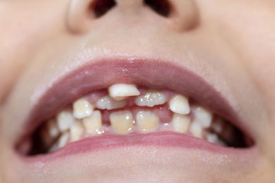 Little boy with open mouth showing milk teeth in front and growing permanent teeth.