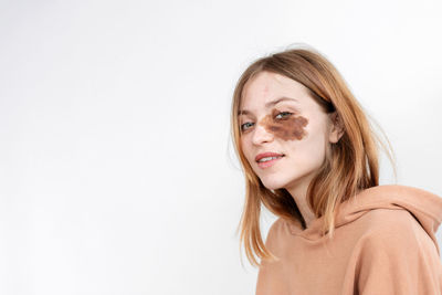 Portrait of a beautiful authentic girl light beige hoodie with birthmarks on her face no makeup