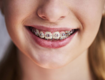 Close-up of smiling girl wearing braces