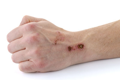 arm