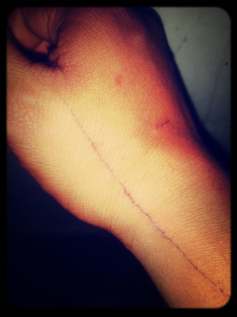 Scar :/