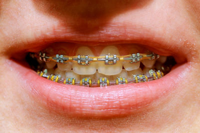 Close-up of person wearing braces