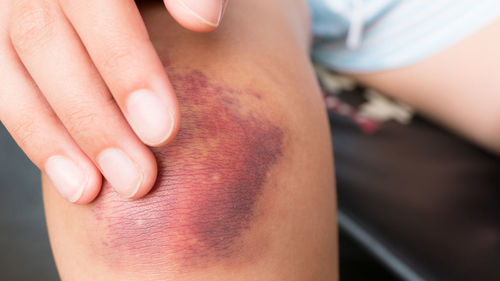 Close-up of woman hand touching wounded knee