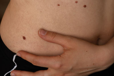 Unrecognizable woman showing her birthmarks on skin close up detail of the bare skin sun exposure