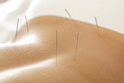 Close-up of acupuncture needles on back