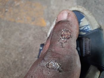 Close-up of wound on toe of diabetic man