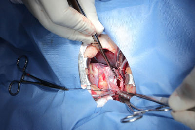 Cropped hands of surgeons doing surgery on patient at hospital