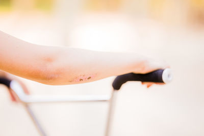 Woman having bruise on hand riding bicycle