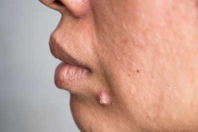 Close-up of woman with pimple on face by gray background