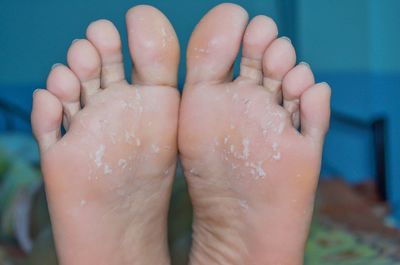 Close-up of injured barefeet