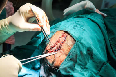 Cropped hand of doctor doing patient surgery