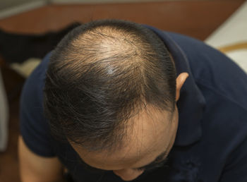 High angle view of man with receding hairline