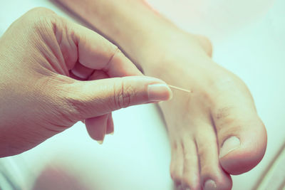 Low section of person with acupuncture needle