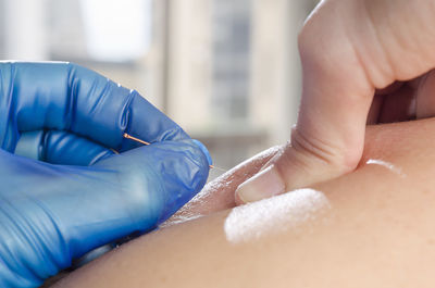 Cropped image of masseur with acupuncture needles